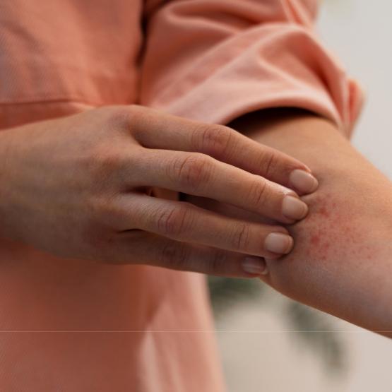 micosis-de-la-piel-sintomas-causas-y-como-tratarlas